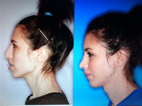Before And After Pictures Of Jaw Surgery Oral Surgery Boca And Delray Fl