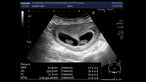 Ultrasound Video Showing Scan Of An Early Twin Pregnancy Youtube