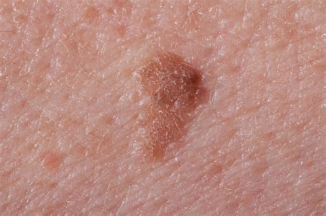 How Often Should You Test For Skin Cancer