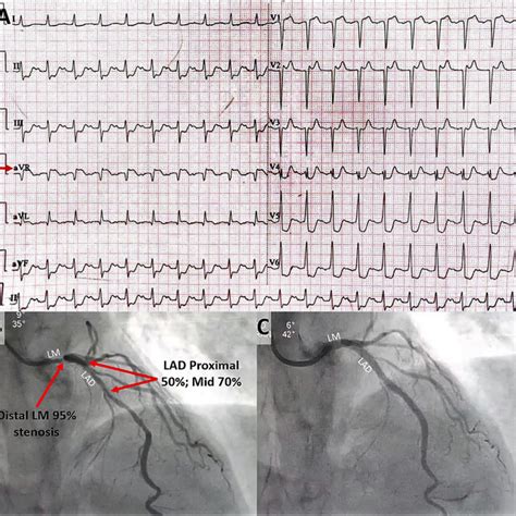 E 12 Lead Ecg Showing Ste In Avr Red Arrow And St Depression In Leads