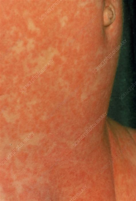 Infant Girl Covered With Measles Rash Stock Image M2100019