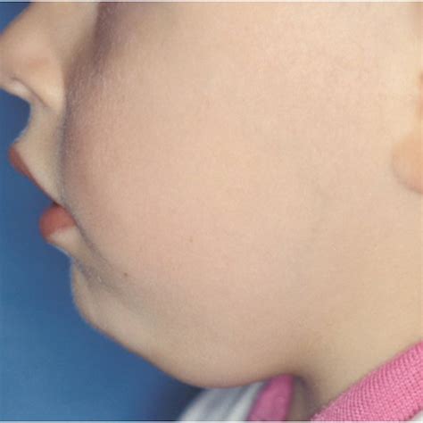 Pdf Cervical Lymph Node Diseases In Children