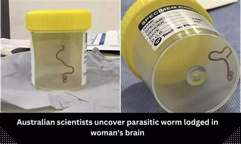 Australian Scientists Uncover Parasitic Worm Lodged In Woman S Brain