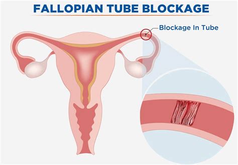 Blocked Fallopian Tube Causes Symptoms And Treatment Healthtian