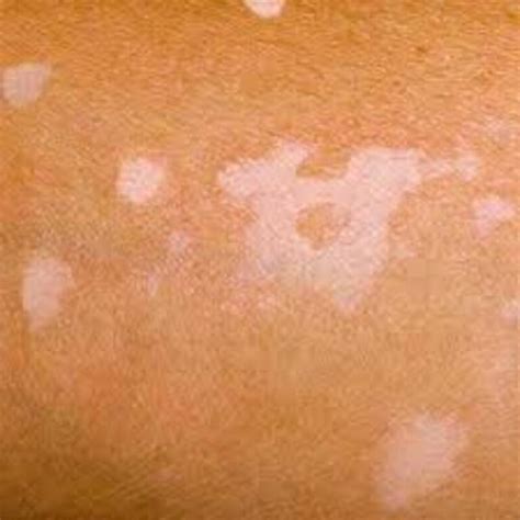 Is Vitiligo Contagious Vitiligo Is A Skin Condition That