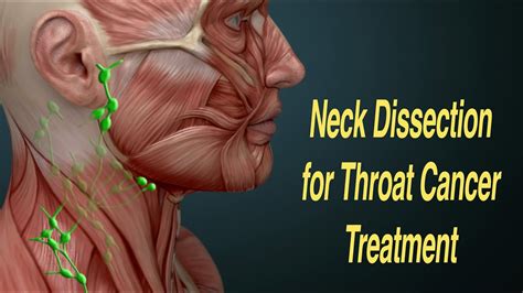Neck Dissection Surgery For Throat Cancer Treatment Mrnd Rnd Youtube