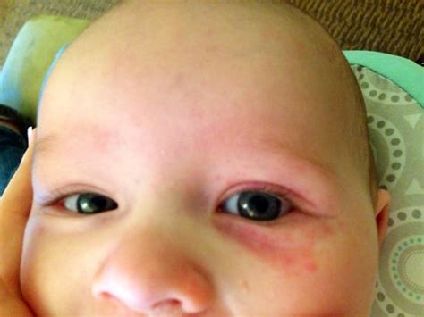Opinions Please Redness Around Los Eye Changing Pediatricians