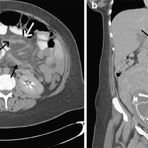 A Transverse Ct Scan Shows Edema Of The Small Bowel Mesentery White