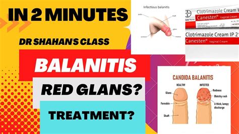 Balanitis Inflammation Of Glans Penis Which Anti Fungal Cream To