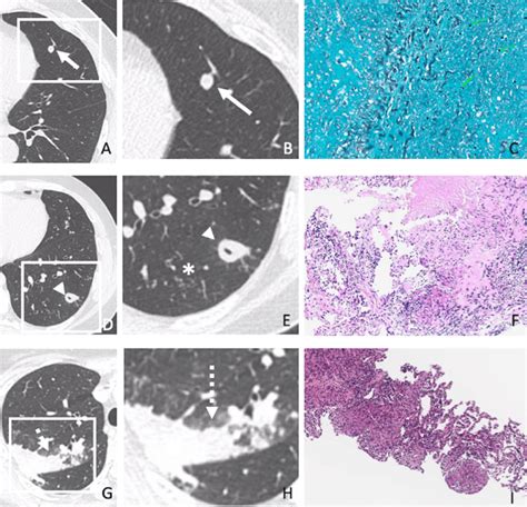 Radiologic Pathologic Correlation Of Three Sample Cases Of Our