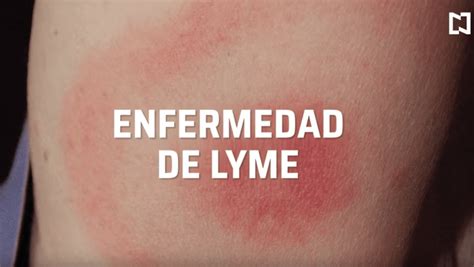 ¿qué Es La Enfermedad De Lyme Y Qué Lo Causa Noticieros Televisa