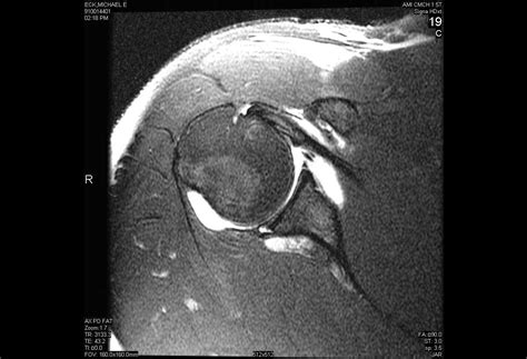 Arthroscopic Repair Of Posterior Labral Tear With Paralabral Cyst