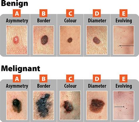 Abcde Chart For Diagnosis Of Cancerous Mole Cancerous Moles Skin Spots Skin Moles