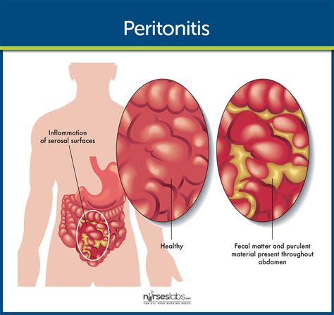 Peritonitis Nursing Care Management And Study Guide