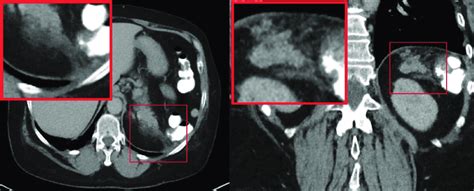 Computed Tomography Of The Abdomen With Intravenous And Oral Contrast