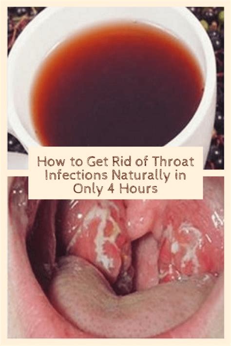 How To Get Rid Of Throat Infections Naturally In Only Hours Throat Infection Sore Throat