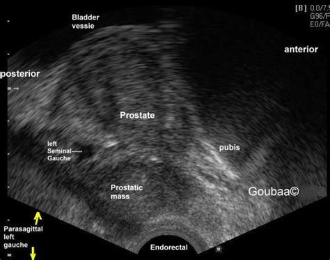 What Is A Transrectal Ultrasound Of The Prostate Bobby Vincent S Blog