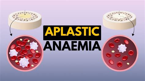 Aplastic Anaemia Causes Signs And Symptoms Diagnosis And Treatment