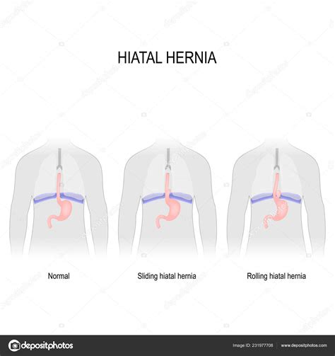 Hiatal Hernia Vector Diagram Van Verschillende Soorten Hiatus Hernia