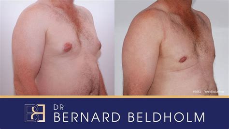 Revision Gynecomastia Surgery Before After This Patient Saw Dr