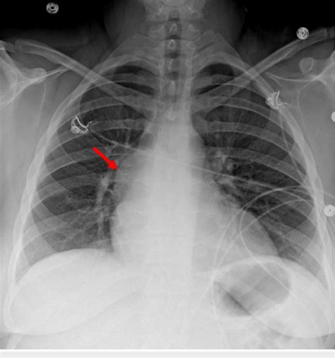 Chest X Ray Posteroanterior View Showing Abnormal Bulging Of The