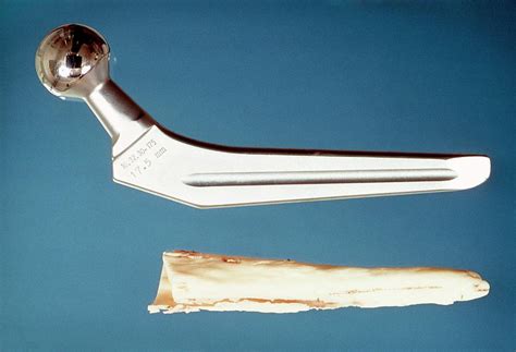 Artificial Hip Joint Photograph By James Stevensonscience Photo