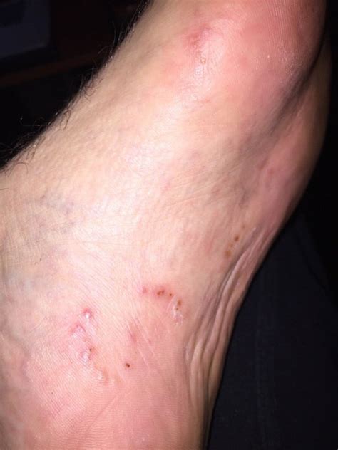 Painful White Spot On Bottom Of Foot Red Rash On Bottom Of Feet