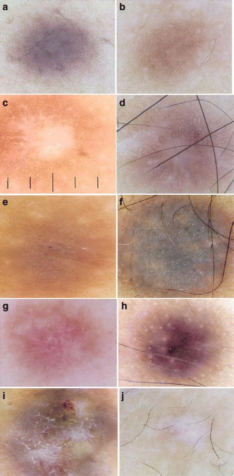 Beyond Classic Dermoscopic Patterns Of Dermatofibromas A Prospective