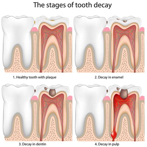 Stages Of Tooth Decay Troy Mi Restorative Dentistry