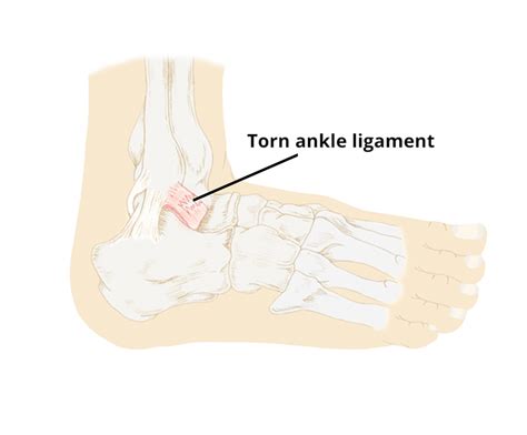 Lateral Ankle Ligament Injury Circle Integrated Care