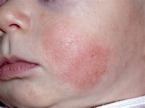 How Do I Know If My Baby Has Eczema Babycenter