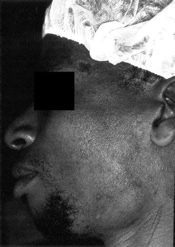 Cervical Tuberculosis Scrofula A Case Report1 Journal Of Oral And