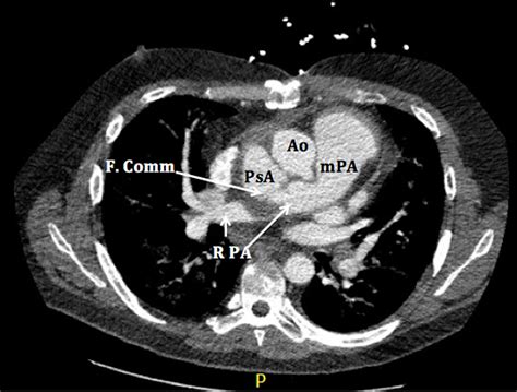Staged Repair Of An Aortopulmonary Fistula From A Large Ascending