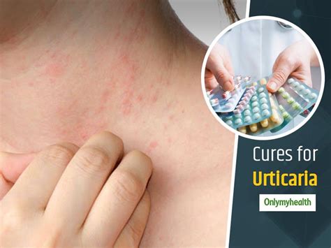 Heres Everything You Need To Know About Urticaria Symptoms Causes