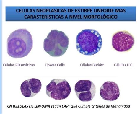 Celulas Neoplasicas Hematología Microbiología Histología