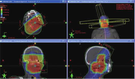 Three Dimentional Conformal Radiotherapy Plan Download Scientific