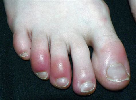 Why Are My Toes Red Causes Other Symptoms And Treatments Swollen