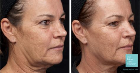 Top 10 Facial Rejuvenation Treatments Uk Best Facials Anti Aging