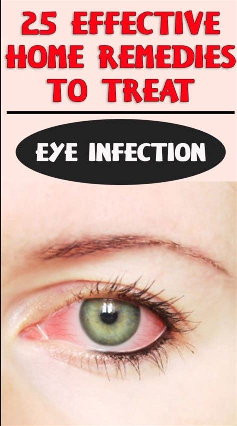 25 Effective Home Remedies To Treat Eye Infection Think Healthy Eye