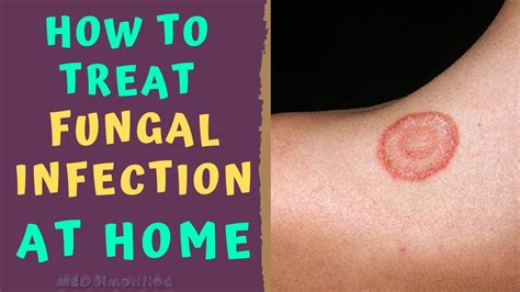 How To Treat Skin Fungal Infection Infection At Home Tinea Ringworm