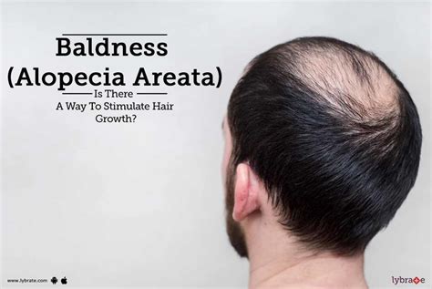 Baldness Alopecia Areata Is There A Way To Stimulate Hair Growth