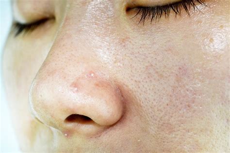 Oily Skin 6 Treatments Causes And Prevention