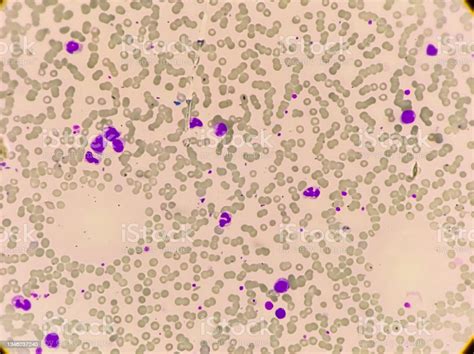 ロイコ赤芽球性貧血と慢性骨髄単球性白血病mpd顕微鏡100xビュー下の血の塗抹標本 実験室のストックフォトや画像を多数ご用意 実験室