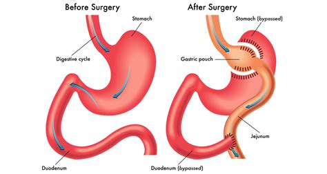 Mini Gastric Bypass And Gastric Bypass What Is The Di
