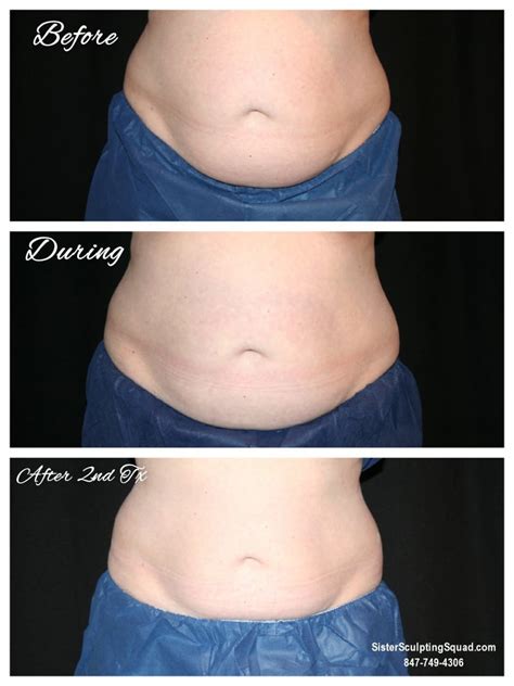 Coolsculpting Before And After Photos Riverside Medical S C