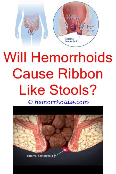 Pin On How To Treat Hemorrhoids