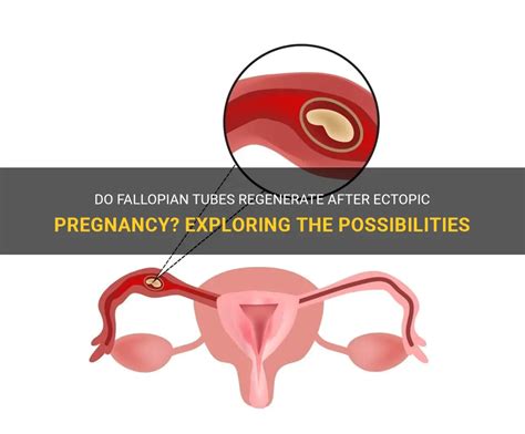 Do Fallopian Tubes Regenerate After Ectopic Pregnancy Exploring The