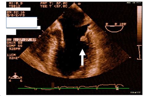 Transesophageal Echocardiogram Depicting Mitral Valve Mass Download Scientific Diagram