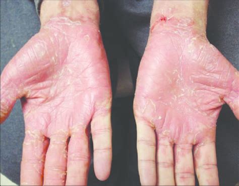 This View Of The Palms Of A 33 Year Old Man With Syphilis Shows