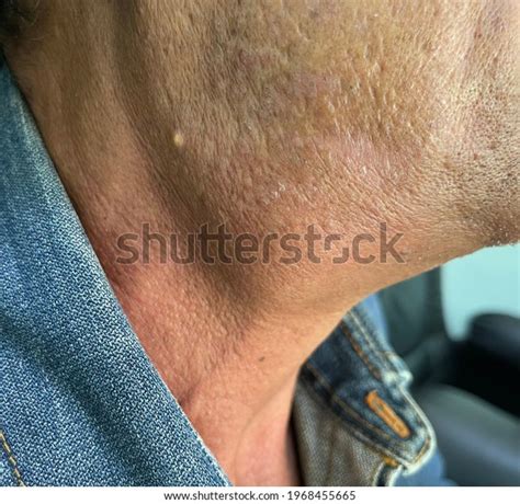 Painful Lump Right Side Neck Case Stock Photo 1968455665 Shutterstock
